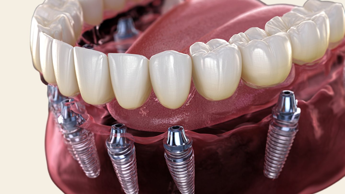 Recreación 3D de una arcada completa sobre implantes